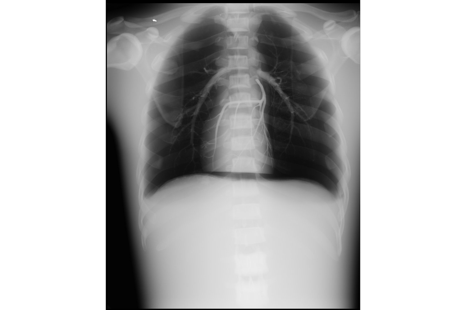 RS-330 肺･胸部ファントム